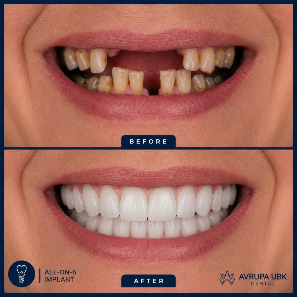 1-all-on-6-woman-result-1-avrupa-ubk-dental-istanbul