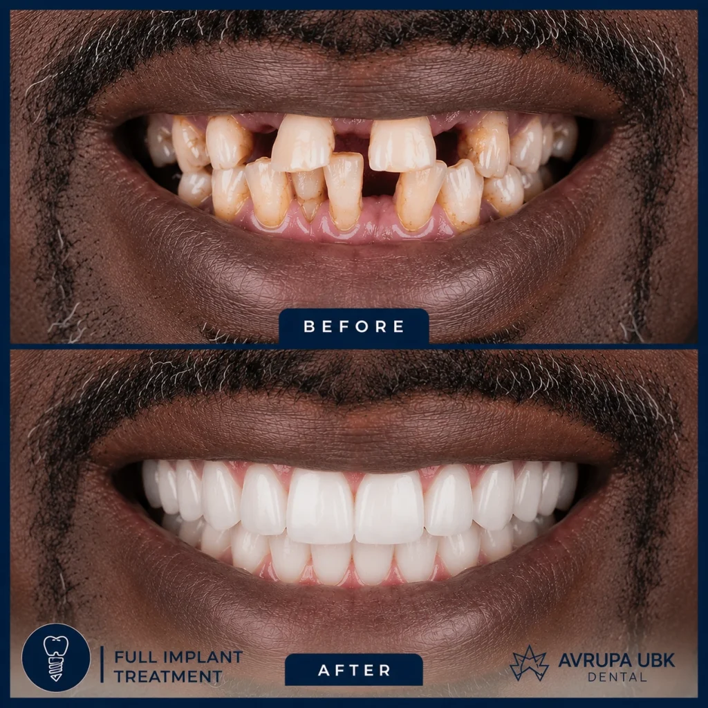 2-full-implant-treatment-man-result-avrupa-ubk-dental-istanbul