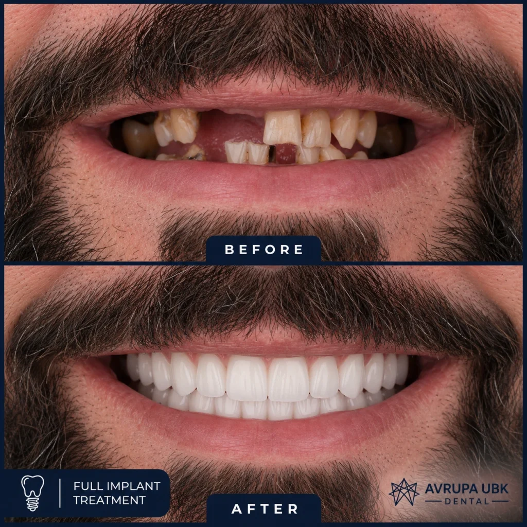 6-full-implant-treatment-man-2-result-avrupa-ubk-dental-istanbul