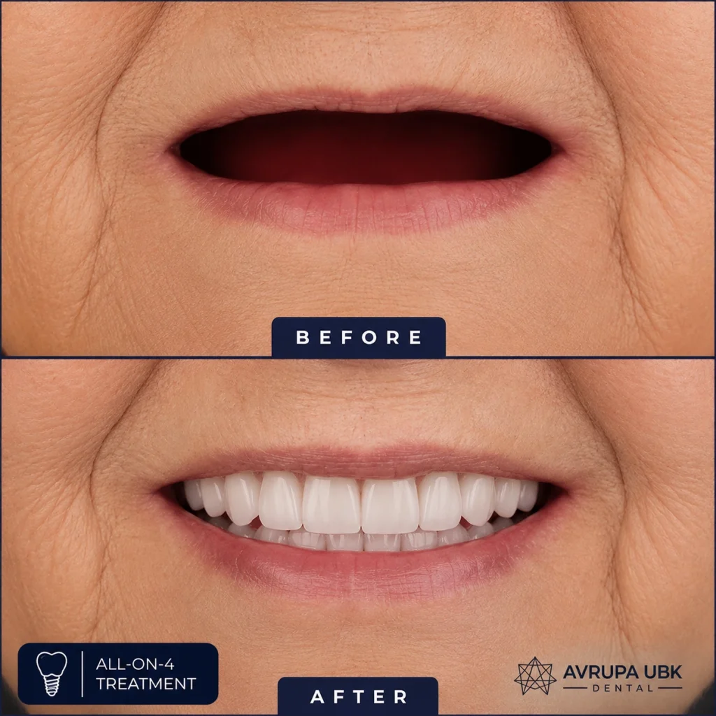 8-all-on-4-woman-result-1-avrupa-ubk-dental-istanbul-final